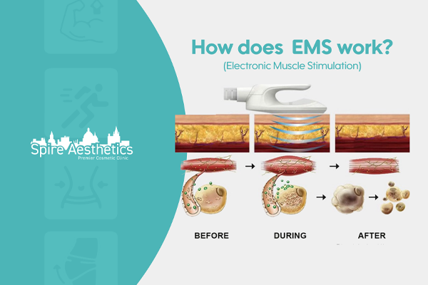 EMS treatment for post pregnancy weight loss treatment Pinner