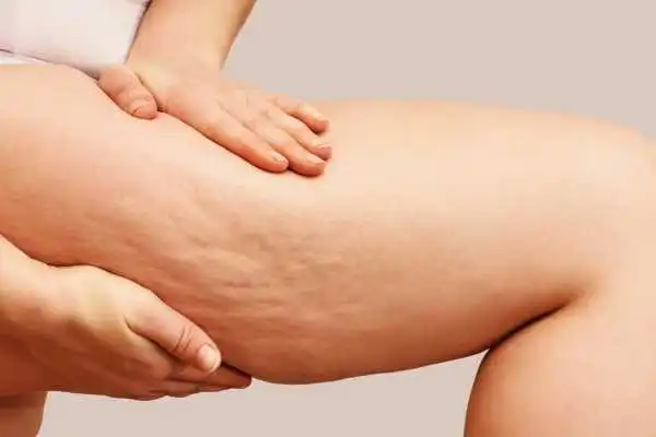 Image of woman showing leg with cellulite Pinner