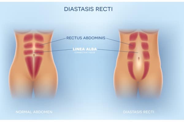 What Non-Surgical Options Are Available for Diastasis Recti Pinner?