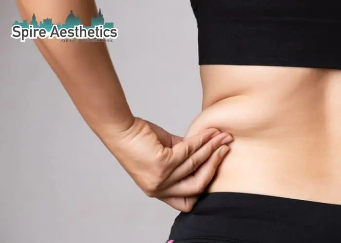 Image of woman pinching fat on their hips Pinner. Fat Freezing treatment