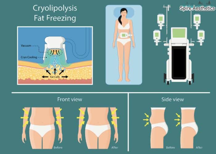 Image of diet and fat freezing combined for best results for Spire Aesthetics Pinner