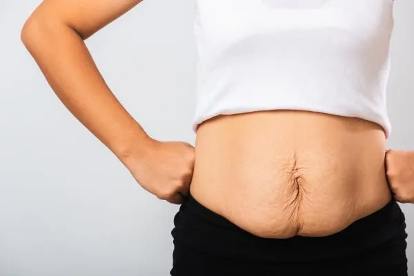 Image of a woman's stomach after weight loss with sagging skin following a gastric band Pinner