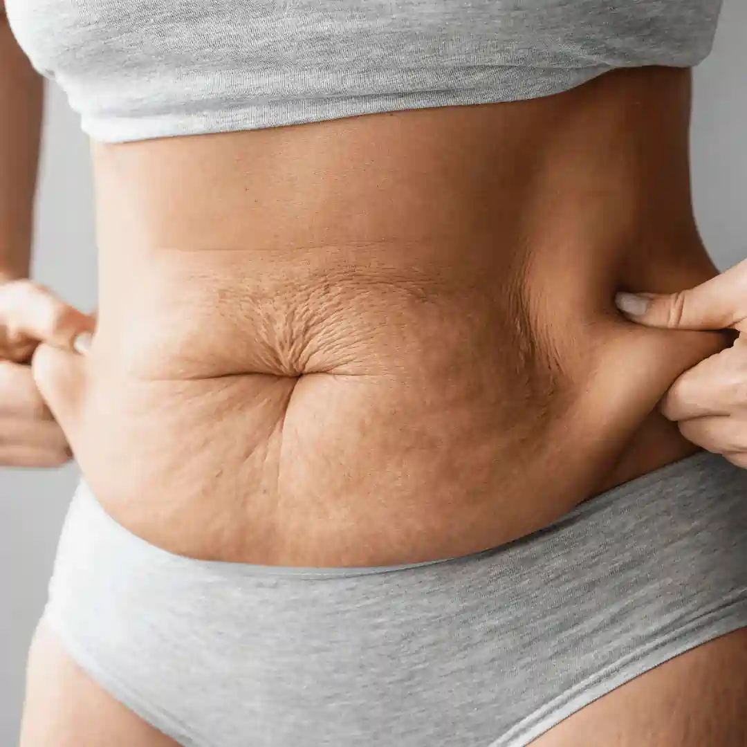 Is It Normal to Have Loose Skin After Pregnancy Pinner?