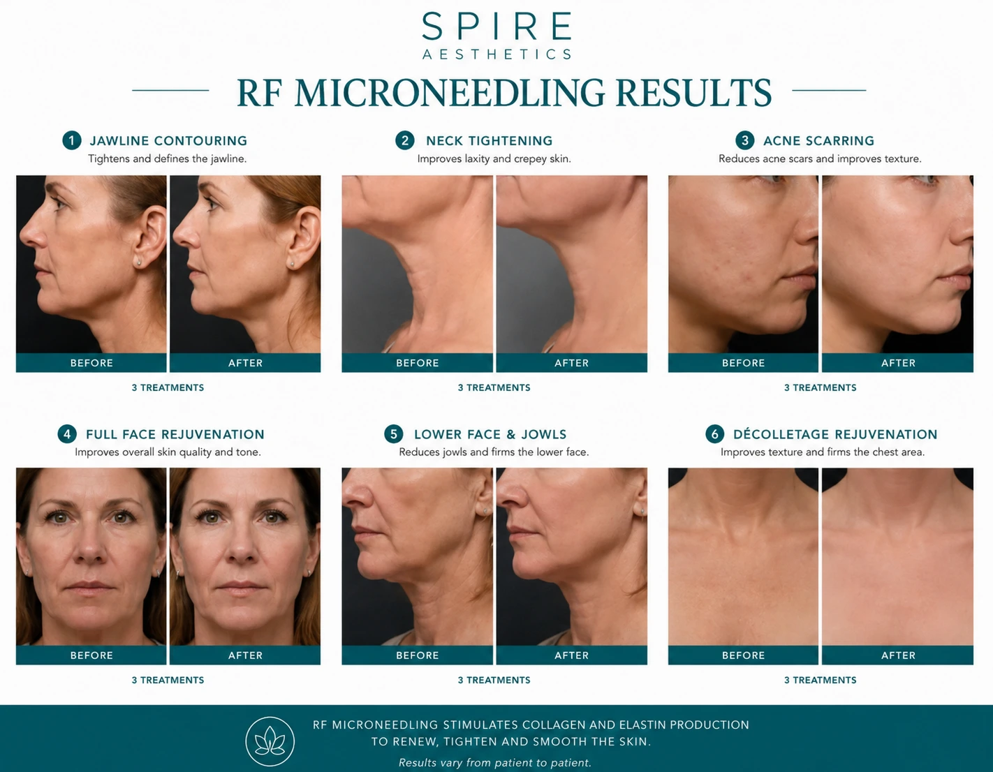 RF Microneedling Skin tightening Pinner results