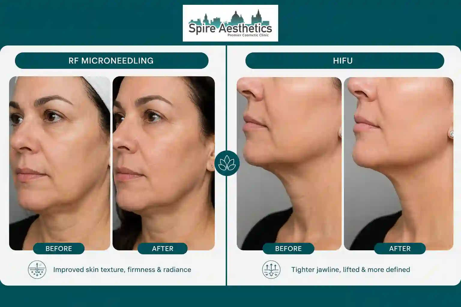 Can RF Microneedling and HIFU Be Combined Pinner?