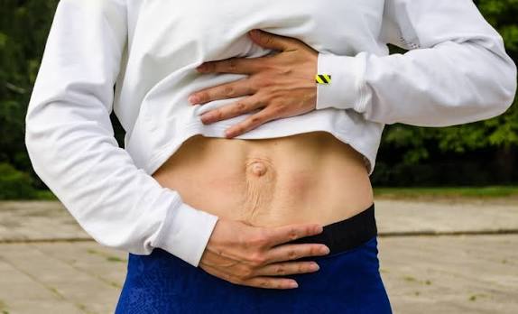 When Could Diastasis Recti Be the Missing Piece of the Puzzle Pinner?
