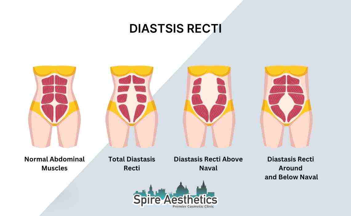 Is Non-Surgical Diastasis Recti Treatment Right for You? Common Concerns Answered Pinner